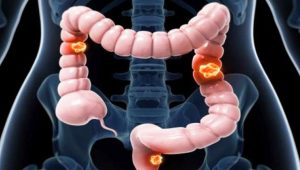 Although cancer is one of the leading causes of death worldwide, colorectal cancer is one of the cancers that we can actually prevent. [PHOTO | COURTESY]