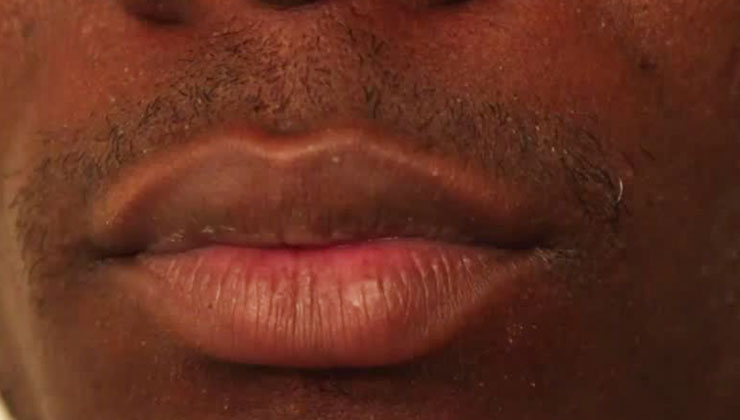 A 34-year-old man from Narok is nursing injuries at the Narok County Referral Hospital after his wife bit off his lower lip. [PHOTO | COURTESY]