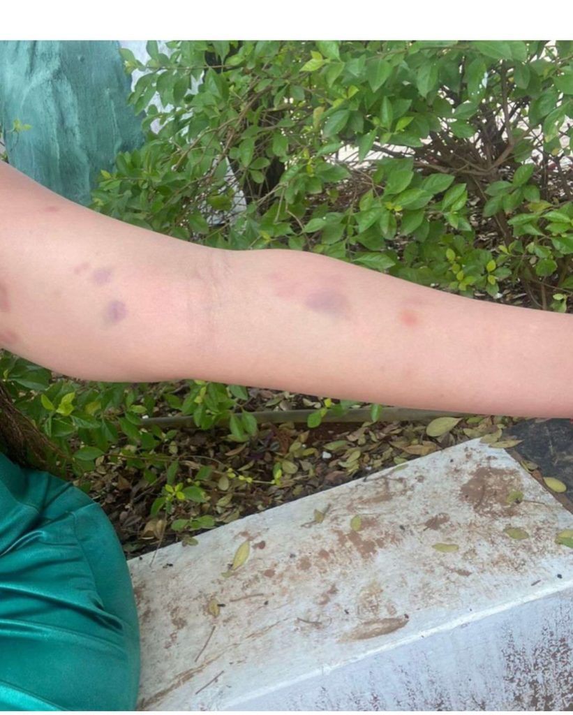 Madtraxx's wife Salma showing her bruises. PHOTO/@hon.salmaenez99/Instagram