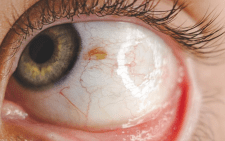 Placenta saves man’s eye after acid-attack