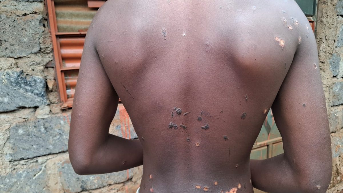 Gatundu North: Family cries for justice after teen is brutally tortured