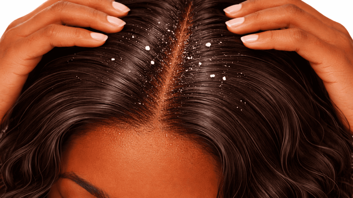 Dandruff explained: causes, myths and what really helps