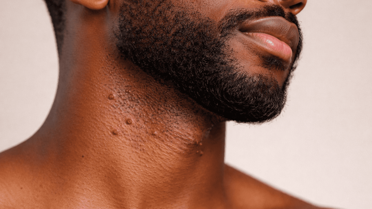 Why you develop pimples after shaving beards