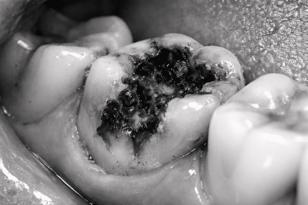 A black and white pic shows a bad tooth.