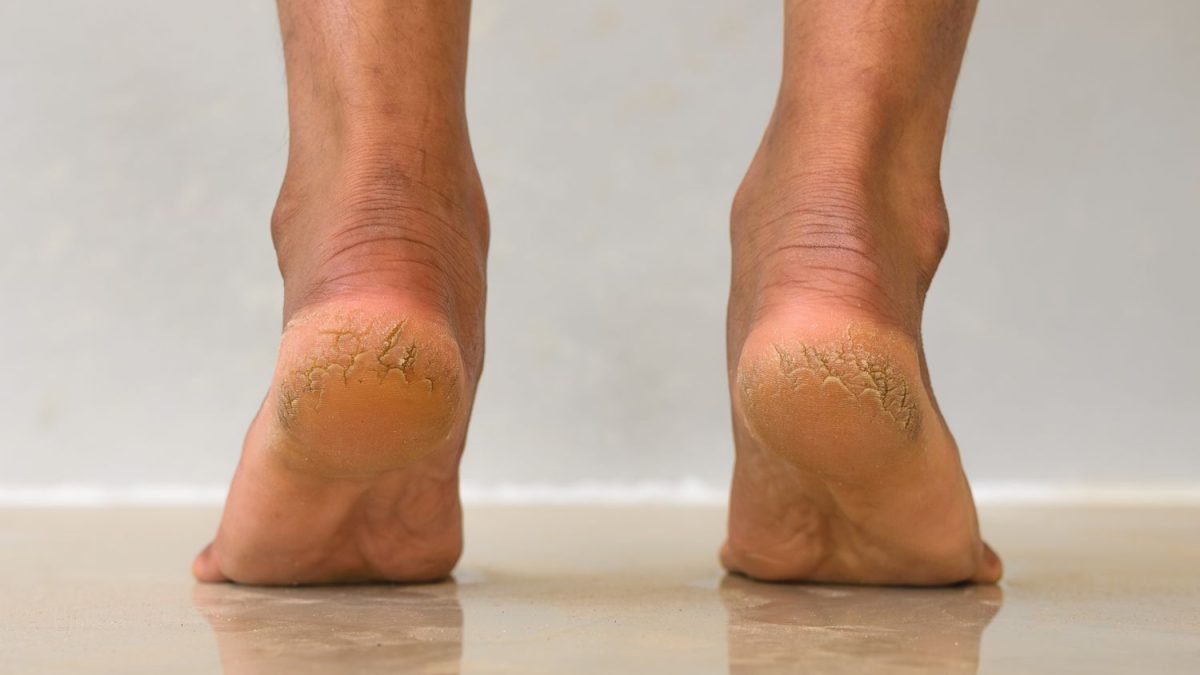 Health signals hidden behind cracked heels and how to prevent them