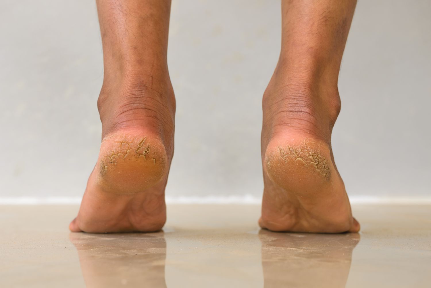 Health signals hidden behind cracked heels and how to prevent them