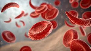 Understanding sickle cell causes, symptoms, diagnosis and treatment options