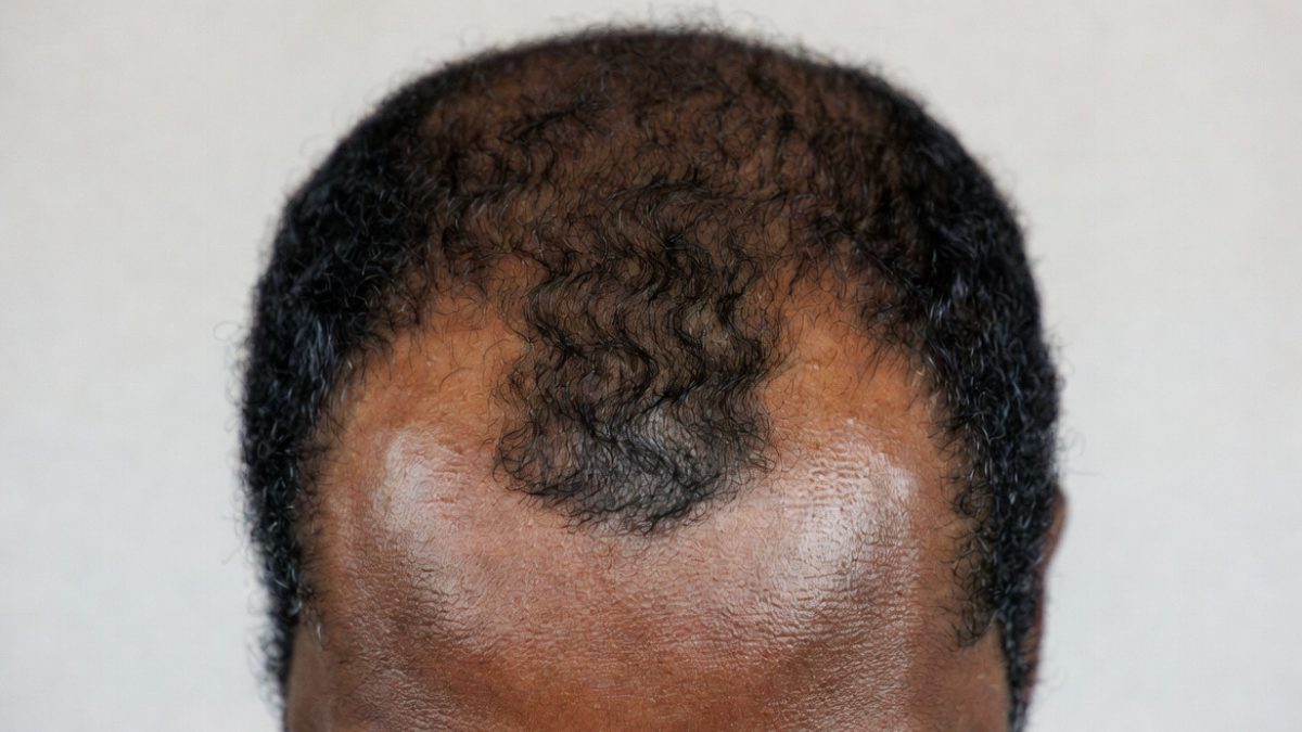 Common habits that may be hurting your hairline