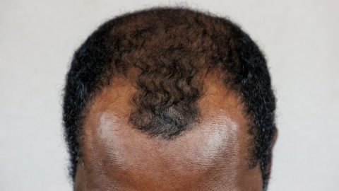 A receding hairline.