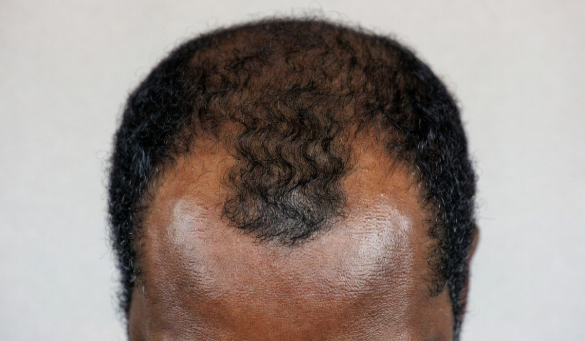 Common habits that may be hurting your hairline