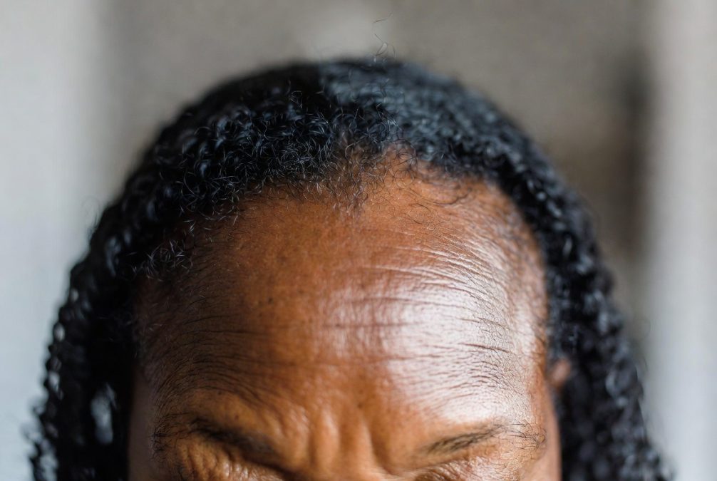 A receding hairline.