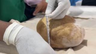 Weighed as much as a baby: Doctors remove giant 3.1kg bladder stone from 55-year-old man