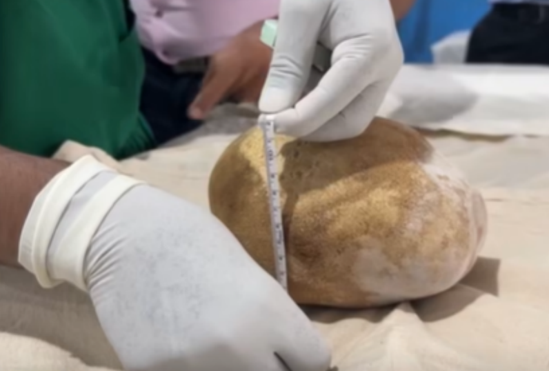 Weighed as much as a baby: Doctors remove giant 3.1kg bladder stone from 55-year-old man