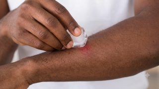 Why you should never put ice or toothpaste on a fresh burn