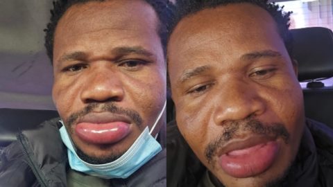 Mumias East MP Peter Salasya showing his swollen lip. PHOTO/@peter_salasya/Instagram