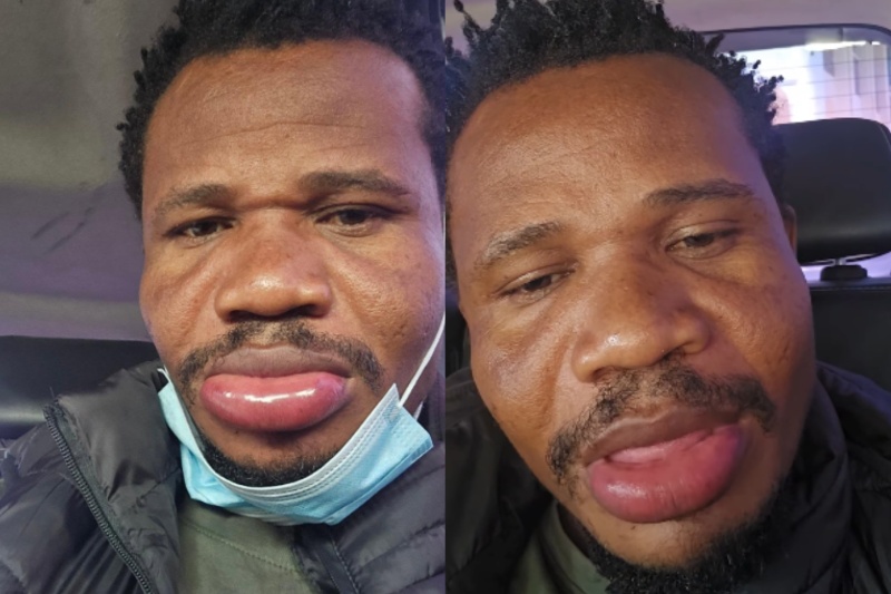 Peter Salasya shares health update after developing swollen lip ahead of rally